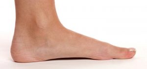 Flat Feet - Posterior Tibial Tendon Dysfunction