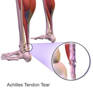 Achilles Tendon Tear Graphic