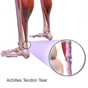 felt pop in achilles tendon