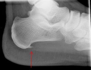 Plantar Fasciitis Heel Spur X-rays