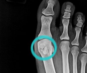 Sesamoid Fracture Injury X Ray